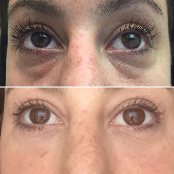 LiftEyes™ Pro