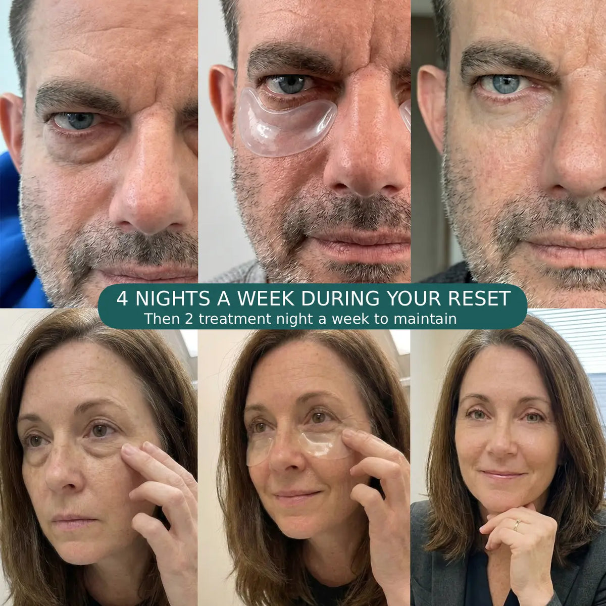 Microneedle Under-Eye Patches