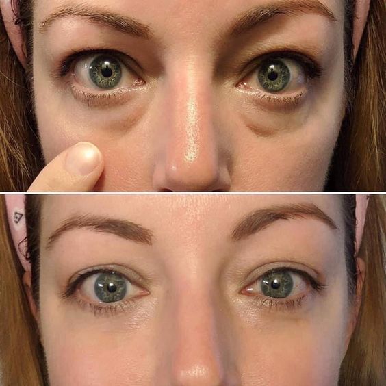 LiftEyes™ Pro