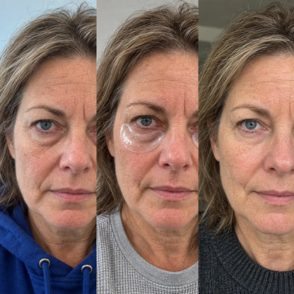 Microneedle Under-Eye Patches